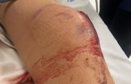 Boy bitten by puff adder at 3 pools along the Drak Gardens Road, Underberg